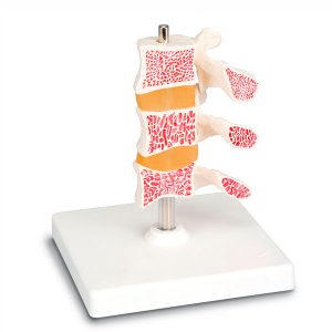 Columna con osteoporosis